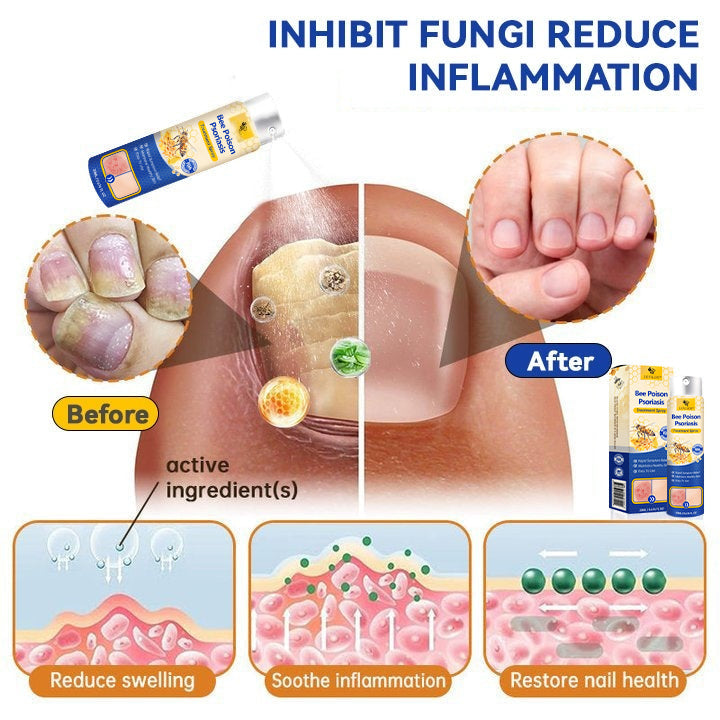 ✨【 official Brand Store】 Last Day Discount: 83% OFF 🌸 LOVILDS™ PsoriaHeal psoriasis Spray pro