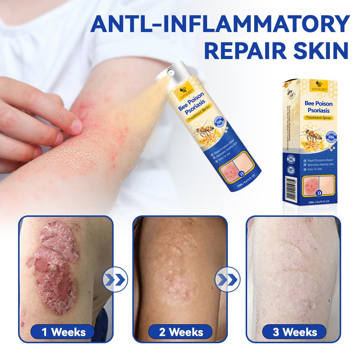✨【 official Brand Store】 Last Day Discount: 83% OFF 🌸 LOVILDS™ PsoriaHeal psoriasis Spray pro