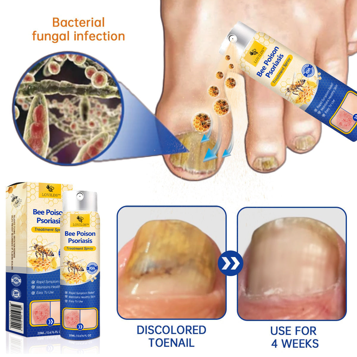 ✨【 official Brand Store】 Last Day Discount: 83% OFF 🌸 LOVILDS™ PsoriaHeal psoriasis Spray pro