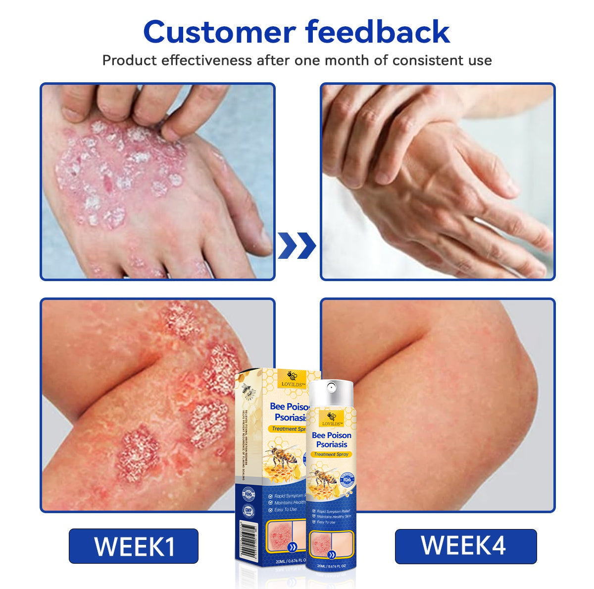 ✨【 official Brand Store】 Last Day Discount: 83% OFF 🌸 LOVILDS™ PsoriaHeal psoriasis Spray pro