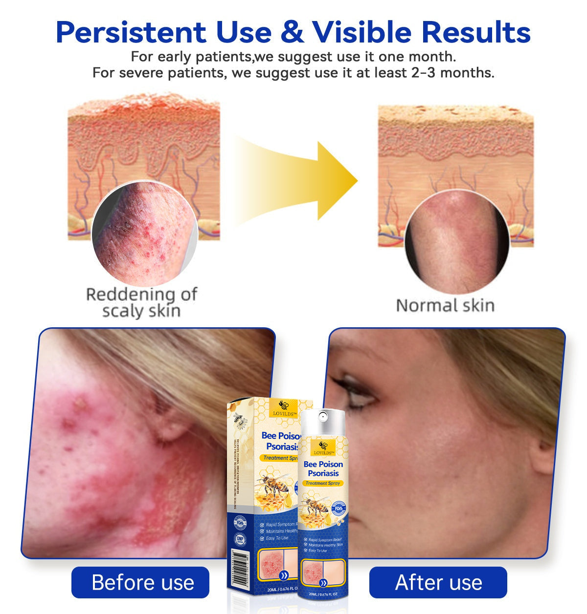 ✨【 official Brand Store】 Last Day Discount: 83% OFF 🌸 LOVILDS™ PsoriaHeal psoriasis Spray pro