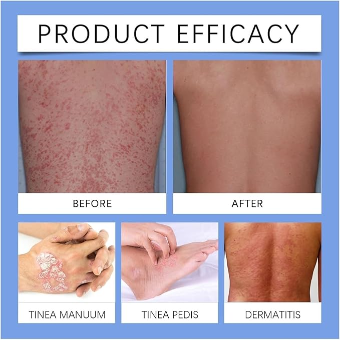 ✨【 official Brand Store】 Last Day Discount: 83% OFF 🌸 LOVILDS™ PsoriaHeal psoriasis Spray pro